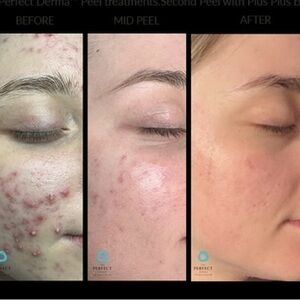 THE PERFECT DERMA™ PEEL